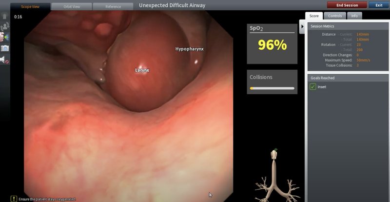 Simulationsansicht eines unerwartet schwierigen Atemwegs mit Hypopharynx